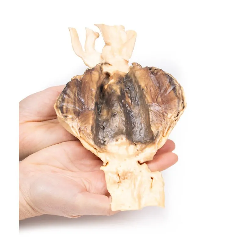 3D Printed Abdominal Aortic Aneurysm